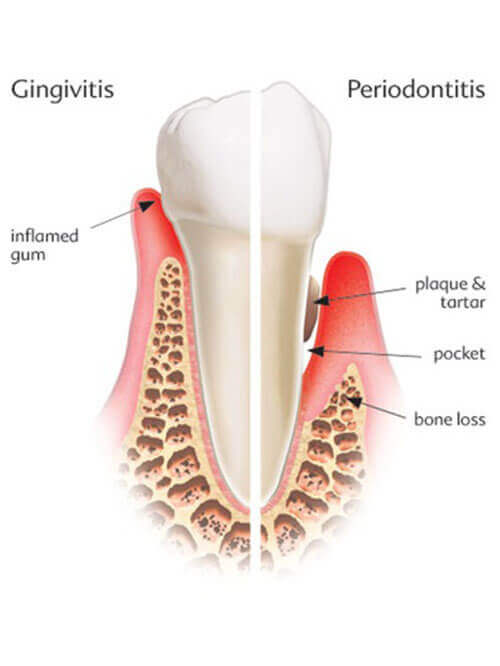 Periodontal